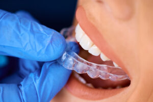 Gloved hand inserting a clear dental aligner onto a person's visible, white teeth, conveying precision and care in orthodontic treatment.