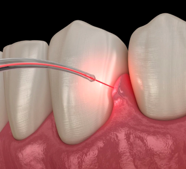 Better Care, Less Discomfort With Laser Technology