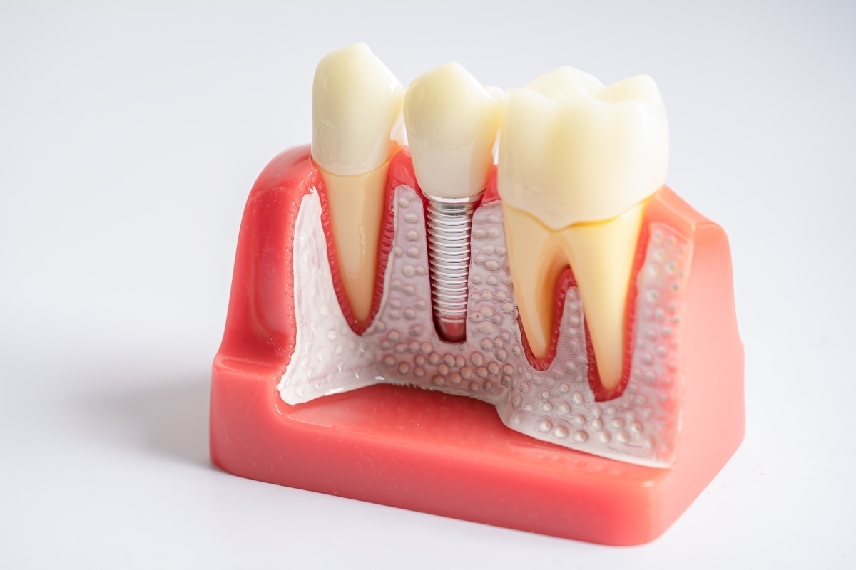 Dental implant cross-section model showing titanium screw, crown, and surrounding gum tissue anatomy.